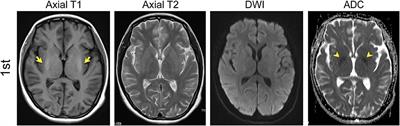 Anti-Dopamine Receptor 2 Antibody-Positive Encephalitis in Adolescent